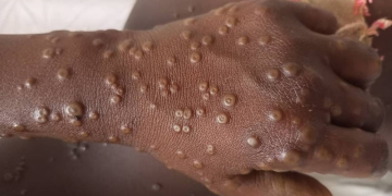 Mpox : les comportements à adopter pour éviter la maladie